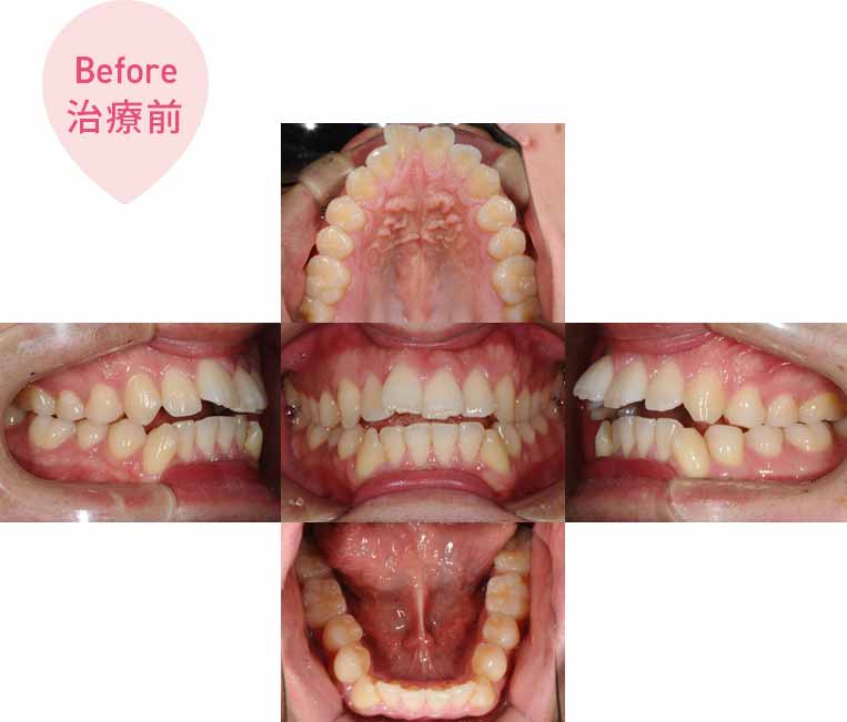 前歯が咬まない：インビザライン治療（非抜歯）