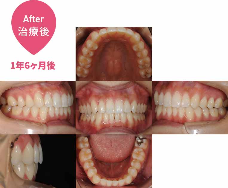 上の前歯が1本前に出ている：インビザライン治療（非抜歯）