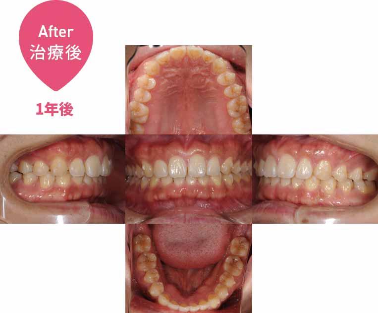 前歯のすきっ歯が気になる：インビザライン治療（非抜歯）