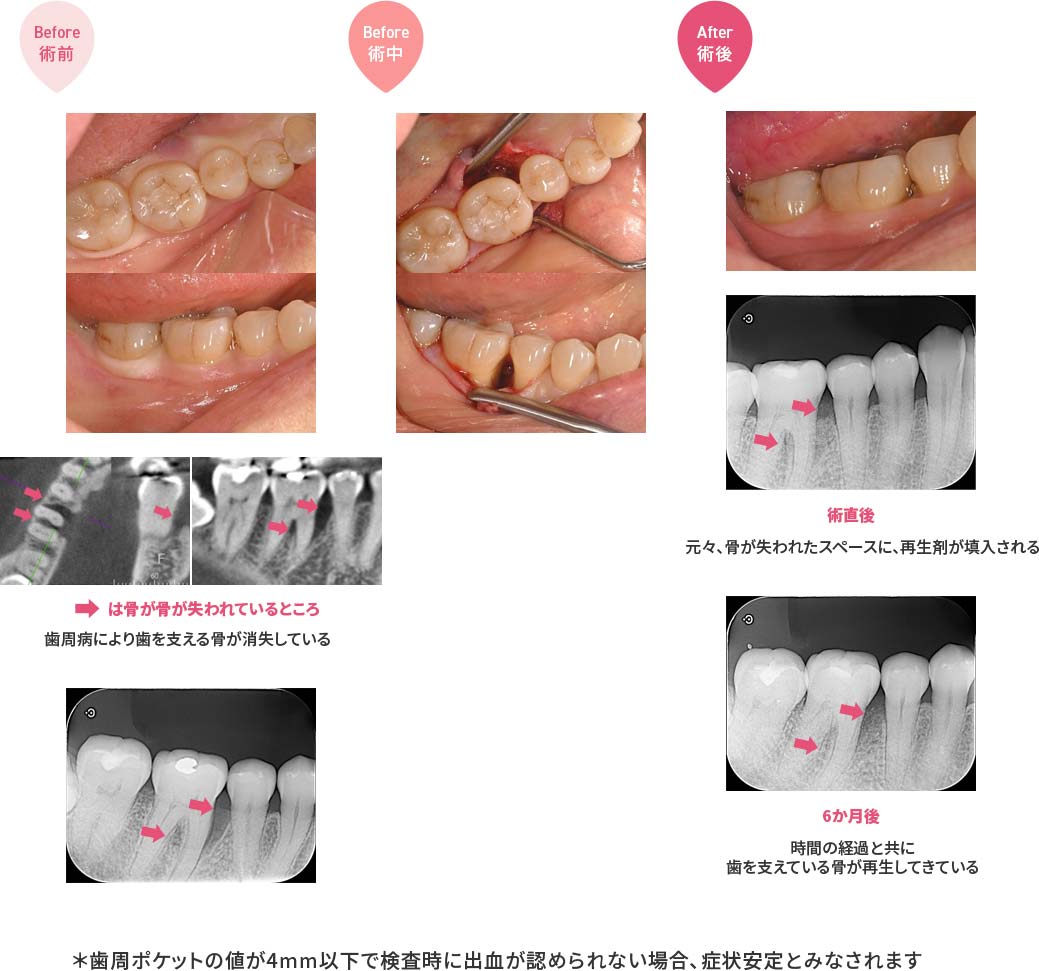 治療内容：リグロス + FDBA + Bio-Gide リグロスを含めた歯周組織再生材を使用