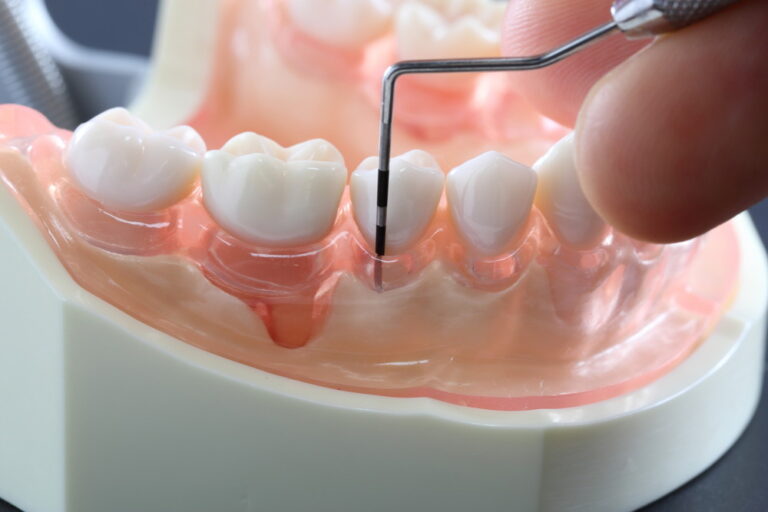歯周病の原因は？