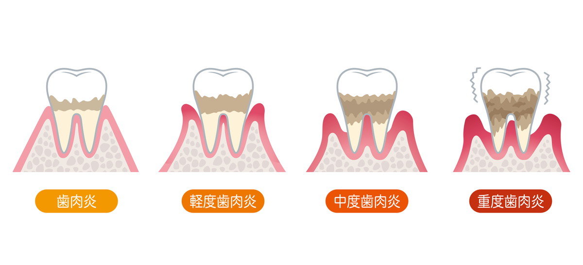 歯周病の進行別治療法