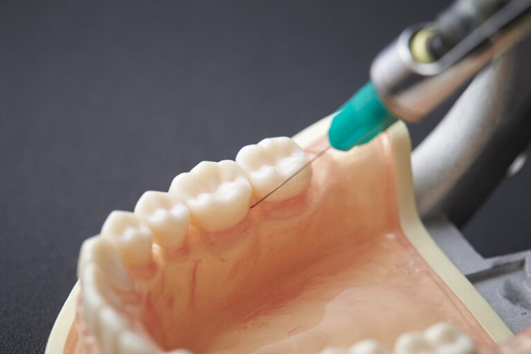 虫歯治療は早期治療・早期発見が大切