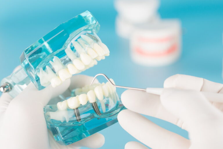 歯を失った時の治療の１つ「インプラント治療」